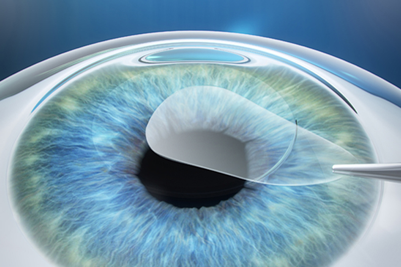 Technique SMILE de Zeiss : Pourquoi le Dr SEIFEDDINE David privilégie l'OCTAVIUS pour vos yeux
