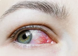 Rosacée oculaire avec rougeur de l’œil observée en consultation ophtalmologique