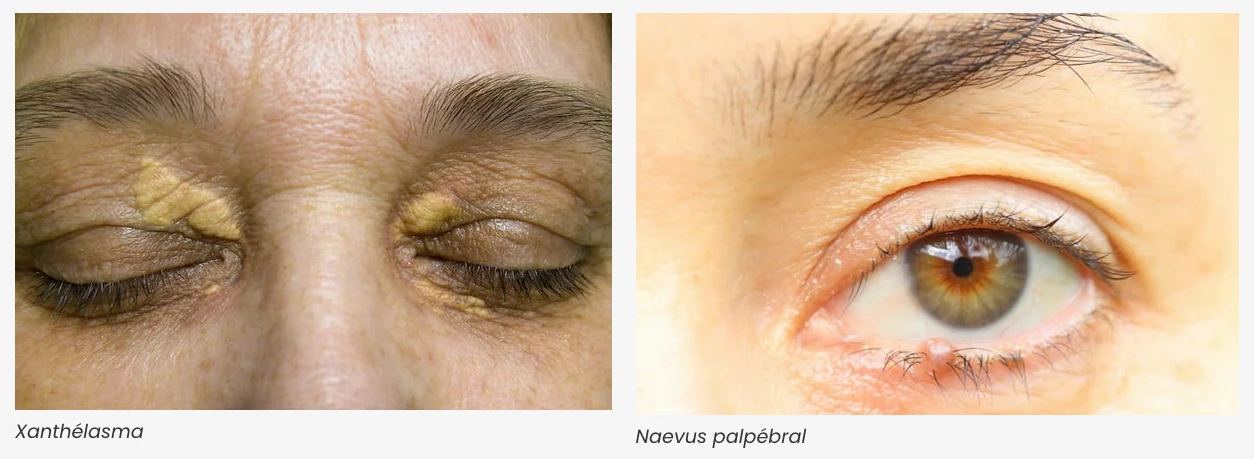 Deux types de tumeurs aux paupières
