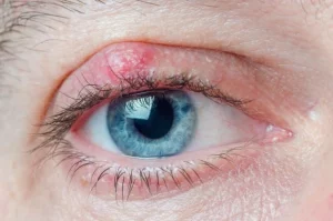 Traitement chalazion Clinique de la vue Lyon, Roanne, Givors