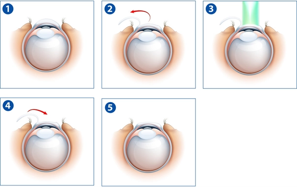 Chirurgie LASIK à Lyon pour corriger la vision au laser