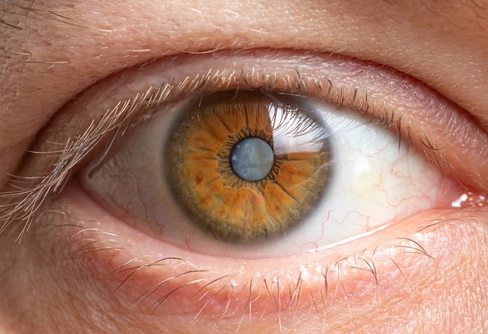 Œil atteint de cataracte avec opacification du cristallin avant chirurgie de la cataracte