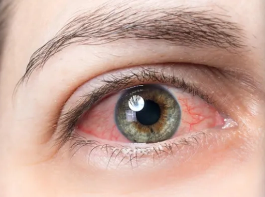 Oeil rouge Voies Lacrymales