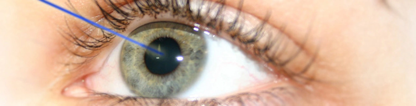 Traitement laser de la presbytie lors d’une chirurgie réfractive à la Clinique de la vue Lyon, Roanne et Givors
