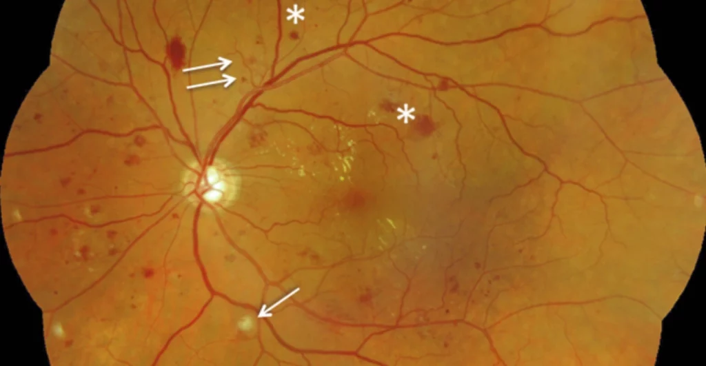 Rétinopathie diabétique observée au fond d’œil avec lésions des vaisseaux rétiniens