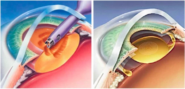 Schéma PRELEX chirurgie du cristallin pour corriger la presbytie et les troubles visuels, Lyon, Roanne et Givors