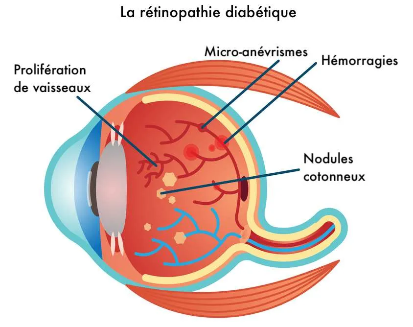 Schéma de la rétinopathie diabétique illustrant les lésions rétiniennes liées au diabète