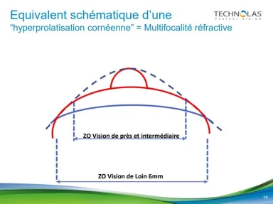 Multifocalité réfractive PresbyLASIK et SupraCor : chirurgie réfractive à Lyon, Givors et Roanne