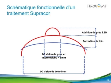 Traitement Supracor de l'oeil PresbyLASIK et SupraCor : chirurgie réfractive à Lyon, Givors et Roanne