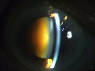 Cristallin opacifié observé en examen ophtalmologique chez un patient atteint de cataracte