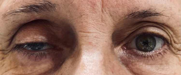 Exemple de malpositions palpébrales avec chute sévère de la paupière supérieure gauche (ptosis), avant intervention chirurgicale dans nos cliniques à Lyon, Roanne et Givors