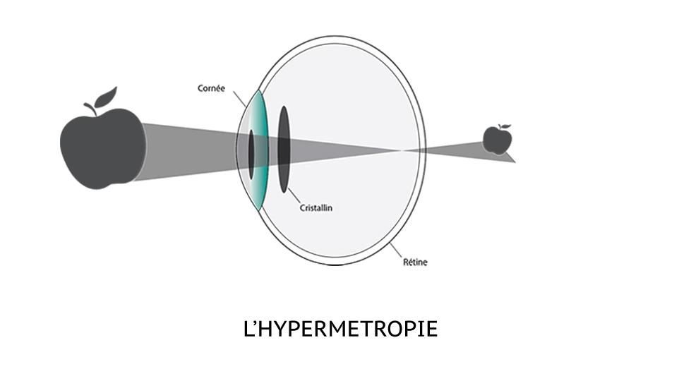 Schéma hypermétropie Schéma explicatif de l'hypermétropie