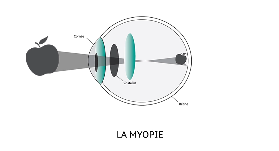 Schéma La myopie Schéma explicatif de la myopie