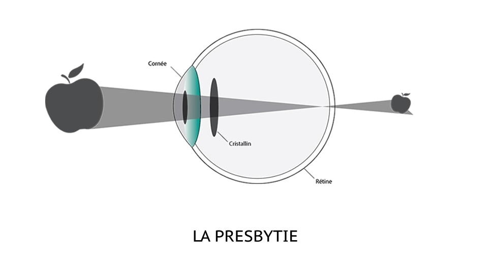 Schéma presbytie Schéma explicatif de la presbytie
