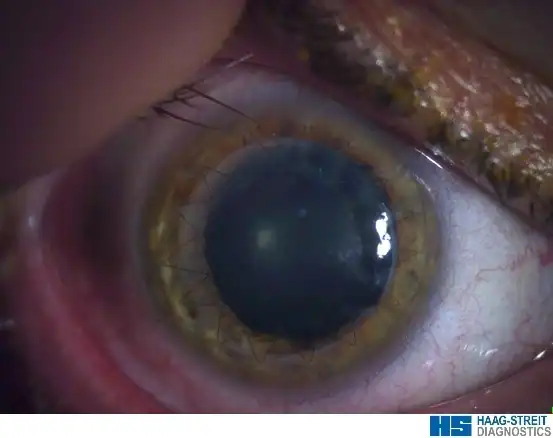 Greffe-de-cornee-transfixiante-realisee-par-le-Dr-Romain-Mouchel-aspect-a-M12 Aspect d’une greffe de cornée transfixiante après kératoplastie avec sutures cornéennes