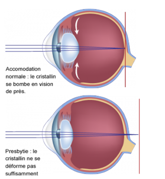 Schéma expliquant pourquoi un oeil est presbyte