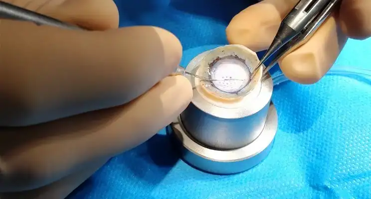 Préparation d’un greffon de cornée avant une kératoplastie réalisée en chirurgie ophtalmologique