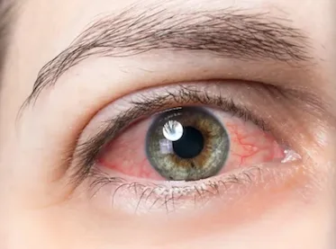 Glaucome et atteinte du nerf optique en ophtalmologie spécialisée à Lyon