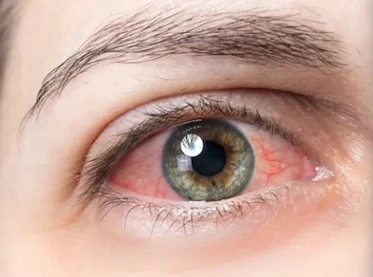 Oeil rouge vois lacrymales Clinique de la vue