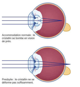 Schéma expliquant pourquoi un oeil est presbyte